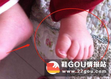 哪些鞋子会导致孩子的双脚变形?